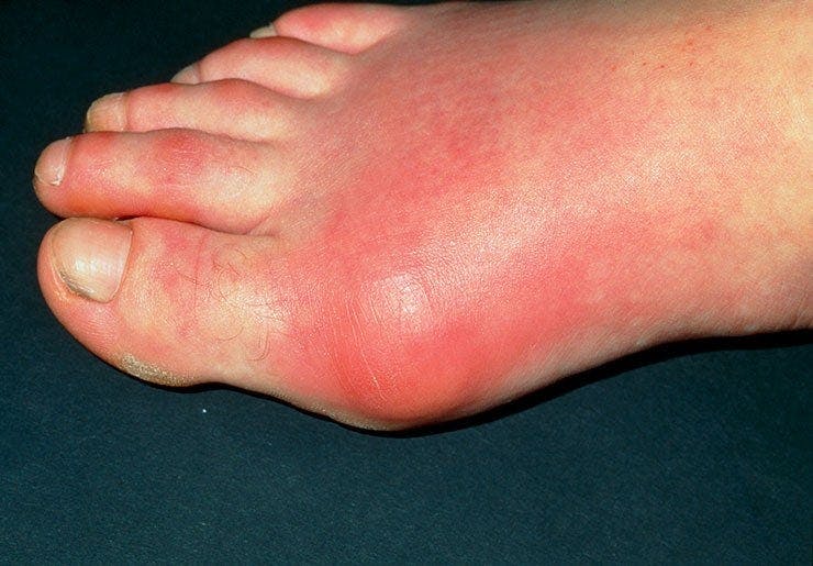 Gout Inflamed toe joint in patient