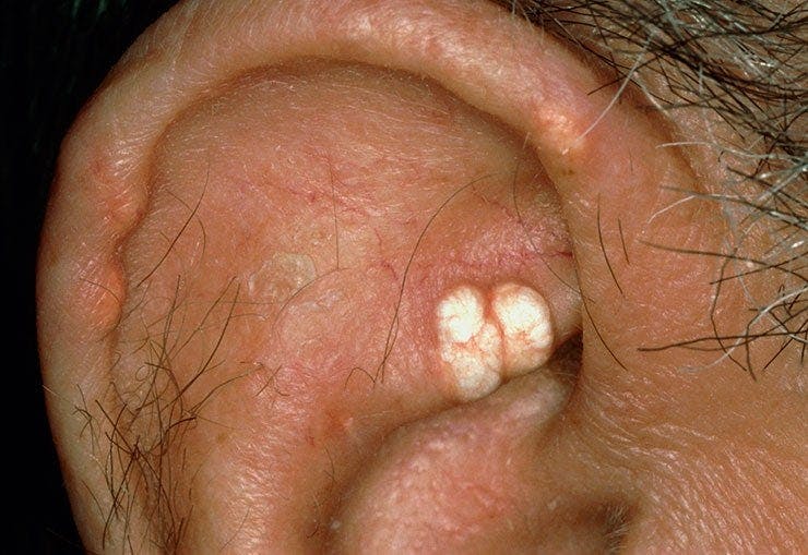 Tophi due to gout on ear